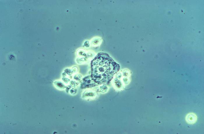 Microscopic Image of Trichomoniasis, an STI.